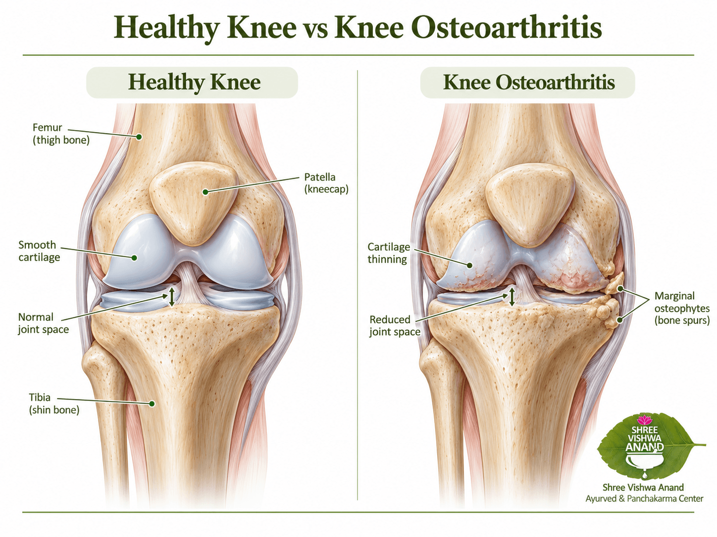Diagram comparing a healthy knee and knee osteoarthritis, with labels for smooth cartilage, normal joint space, cartilage thinning, reduced joint space and osteophytes.