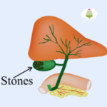 Gallbladder Stone